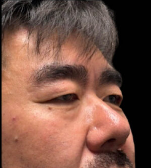 Eyelid Surgery