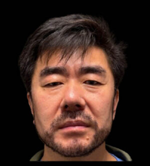 Eyelid Surgery