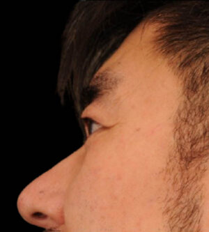 Eyelid Surgery