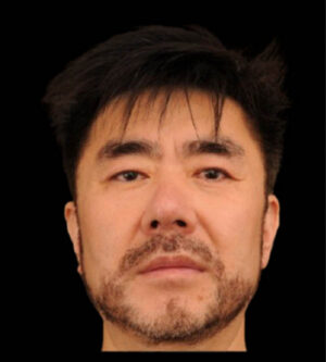 Eyelid Surgery