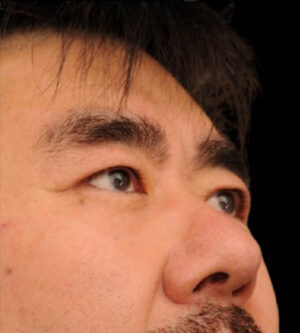Eyelid Surgery