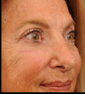Eyelid Surgery