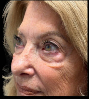 Eyelid Surgery