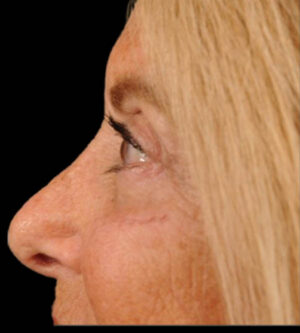 Eyelid Surgery