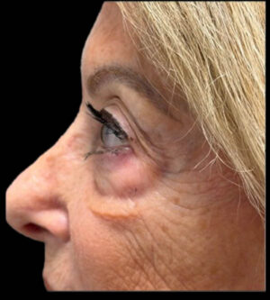 Eyelid Surgery