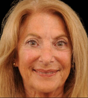 Eyelid Surgery