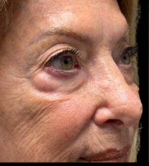 Eyelid Surgery