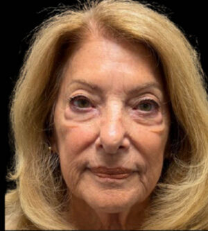 Eyelid Surgery