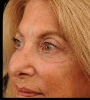 Eyelid Surgery
