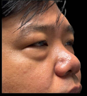 Eyelid Surgery