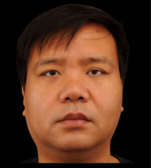 Eyelid Surgery