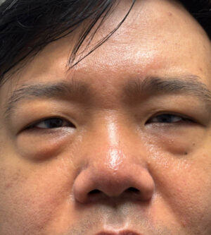 Eyelid Surgery