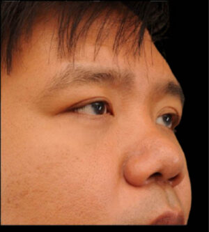 Eyelid Surgery