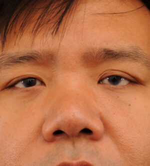 Eyelid Surgery