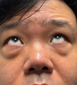 Eyelid Surgery