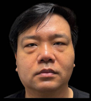 Eyelid Surgery