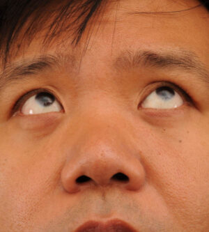 Eyelid Surgery