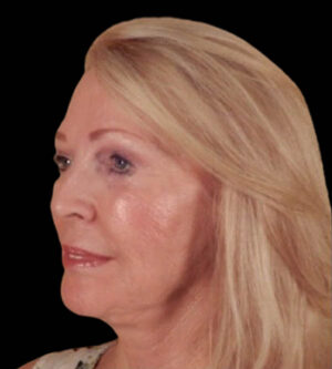 Facelift
