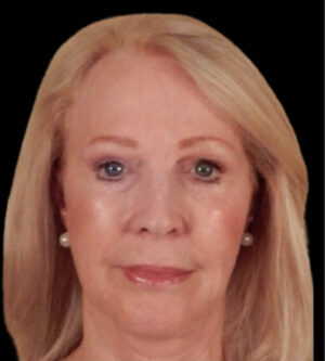 Facelift