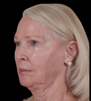 Facelift
