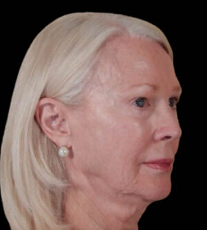 Facelift