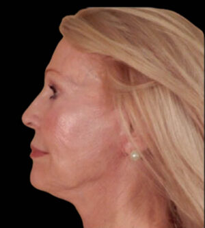 Facelift