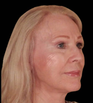 Facelift