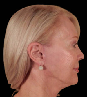 Facelift