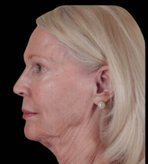 Facelift