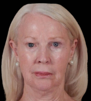 Facelift