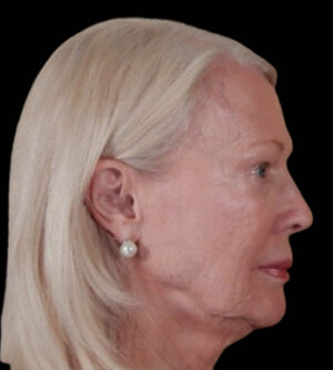 Facelift
