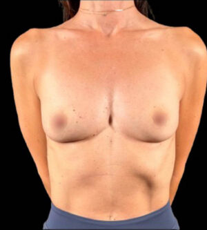 Breast Augmentation