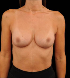 Breast Augmentation
