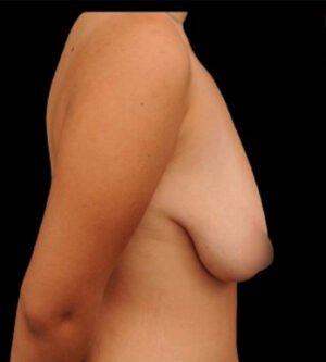 Breast Lift