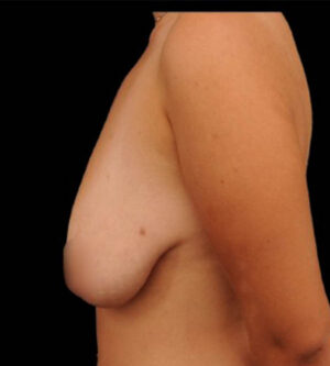 Breast Lift