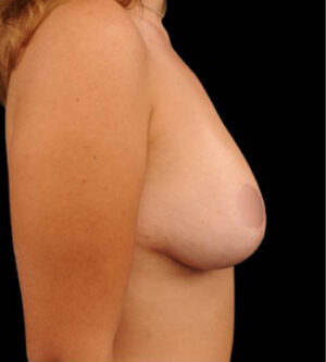 Breast Lift