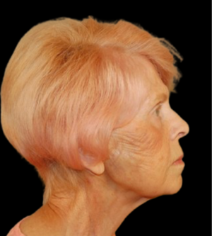 Facelift