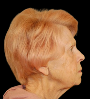 Facelift