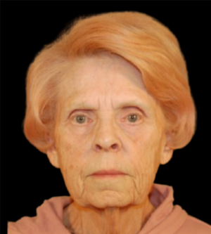 Facelift