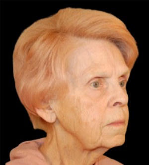 Facelift
