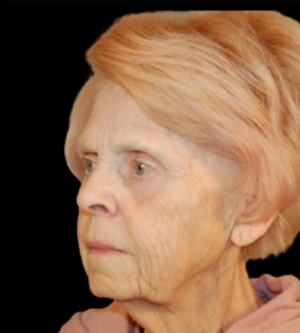 Facelift