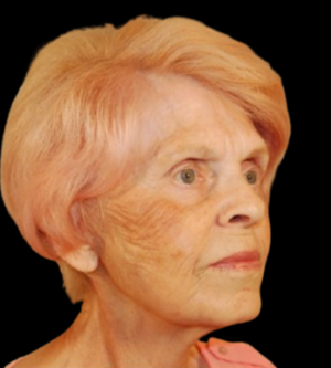 Facelift
