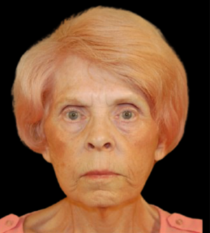 Facelift