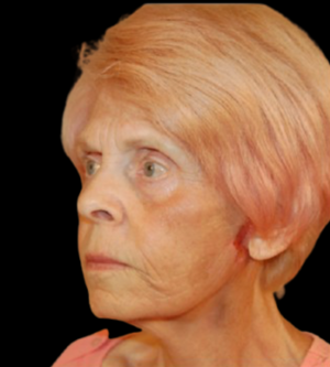 Facelift