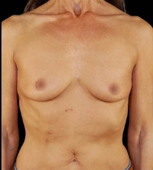 Breast Augmentation