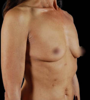Breast Augmentation
