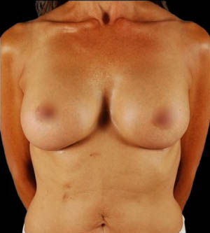 Breast Augmentation