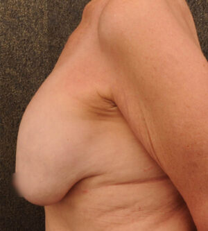 Breast Lift