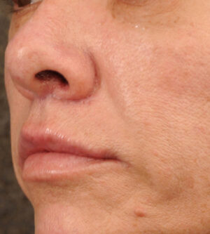 Lip Lift