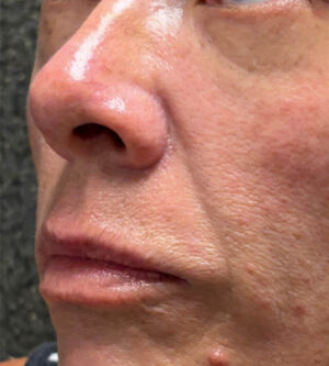 Lip Lift